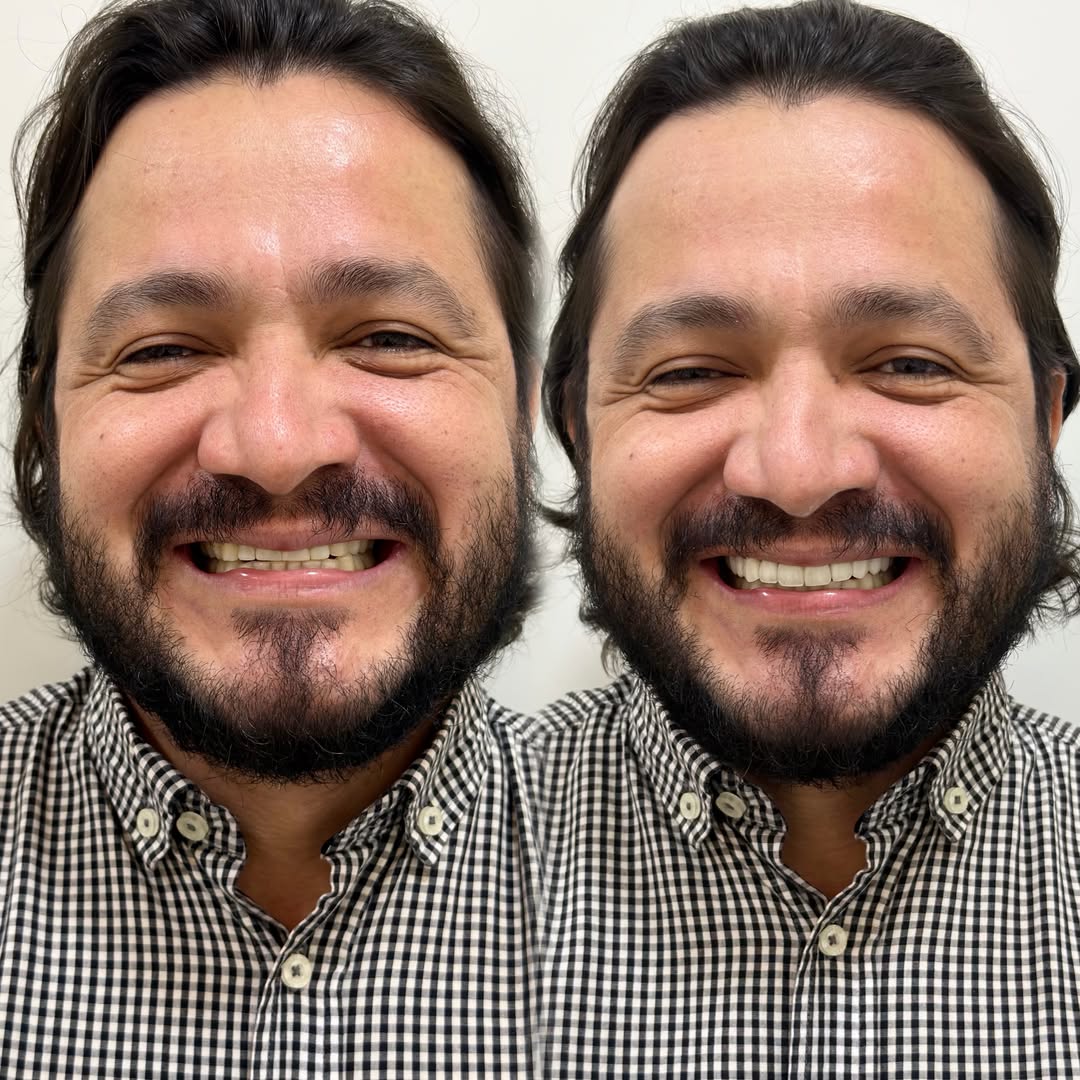 Antes e depois — Lentes em resina
